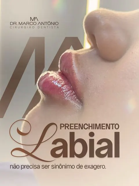 Post sobre preenchimento labial sem exagero