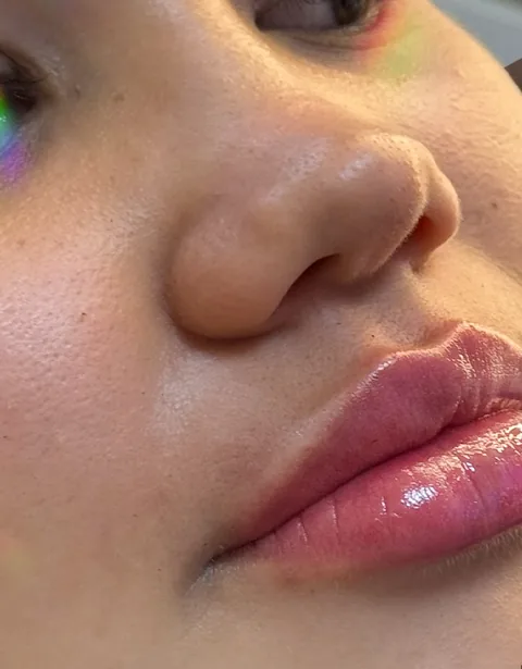 Lábios com preenchimento natural, vistos de lado